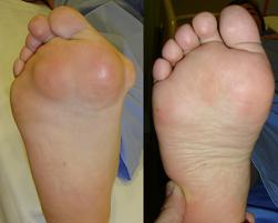 Artrita reumatoidă a degetelor mari de la picioare